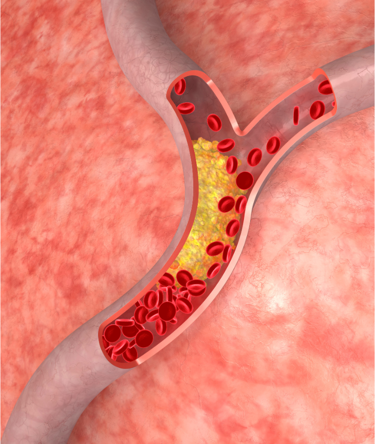 Promoting Healthy Cholesterol Levels