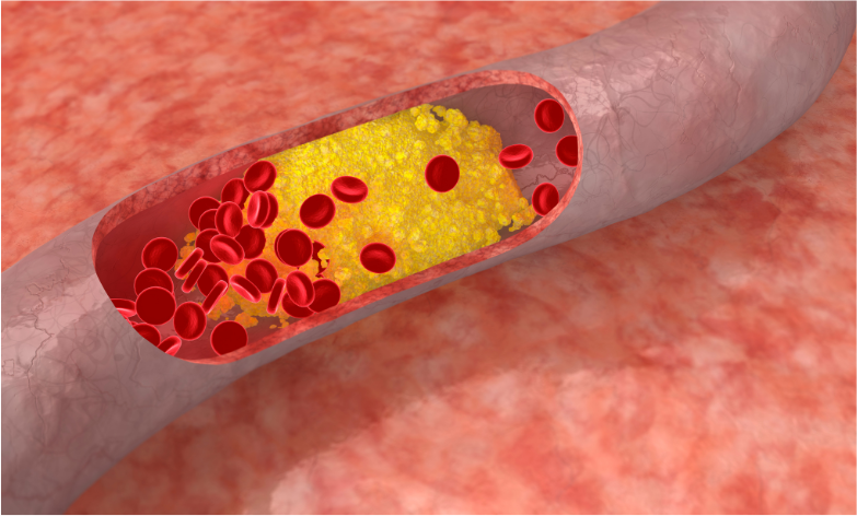 hyperlipidemia